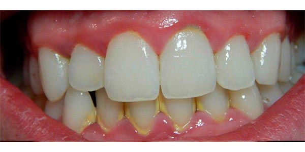 Img-Antes_Despues-LimpiezaDental-1A