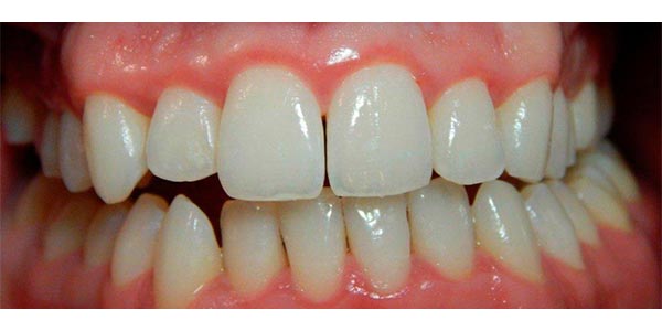 Img-Antes_Despues-LimpiezaDental-1D