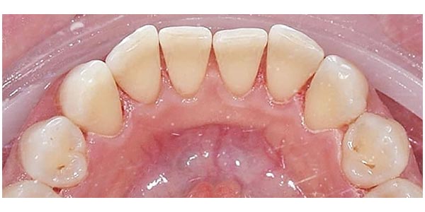 Img-Antes_Despues-LimpiezaDental-2D