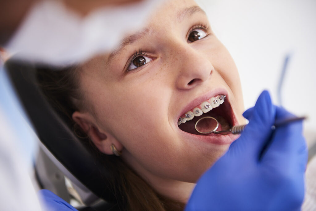 Cuidado de los Brackets en Bogotá: Guía Completa para una Sonrisa Perfecta