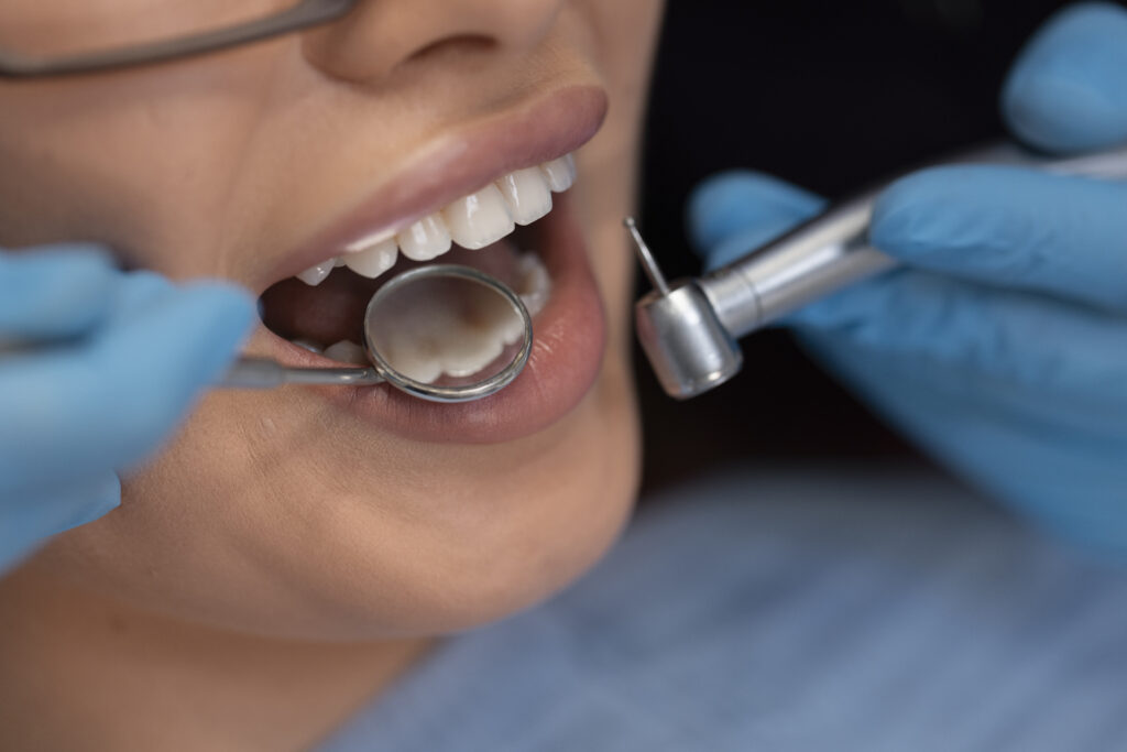 ¿Cuánto tiempo dura un diente después de una endodoncia? Factores que influyen en su duración