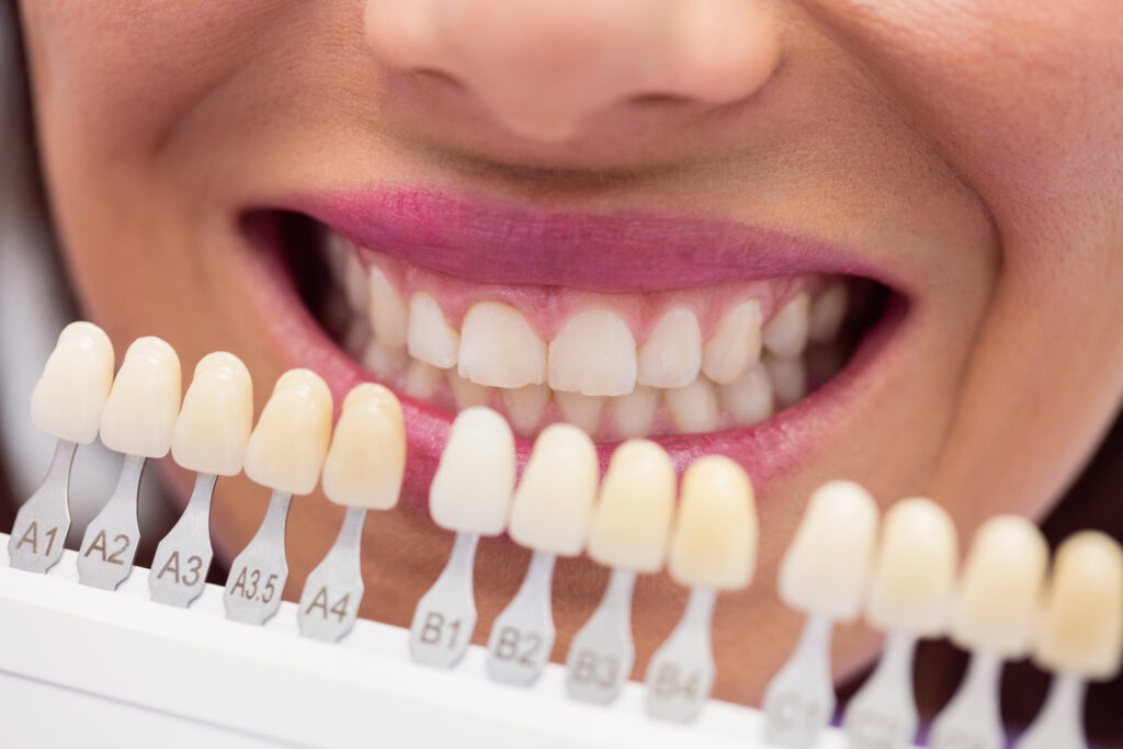 Aclaramiento dental: cómo lograr una sonrisa más blanca y segura