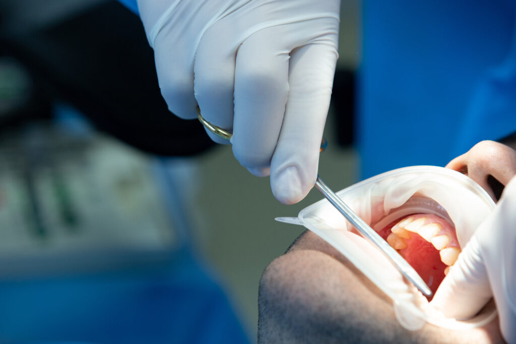 Endodoncia: qué es y cómo saber si la necesitas urgente