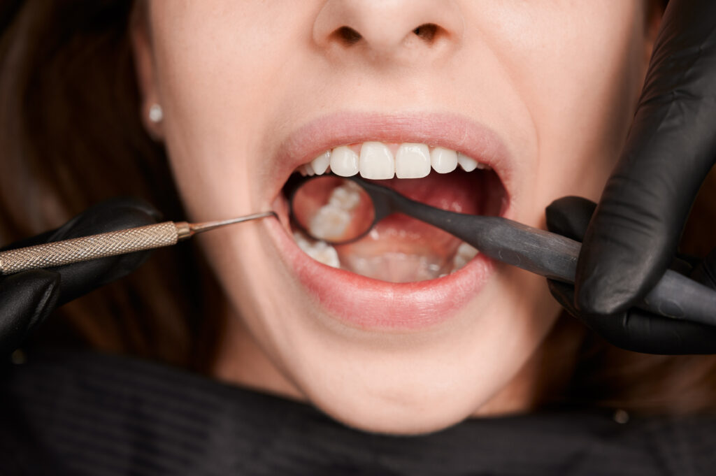 Caries profunda, endodoncia o extracción dental: ¿cuál elegir?